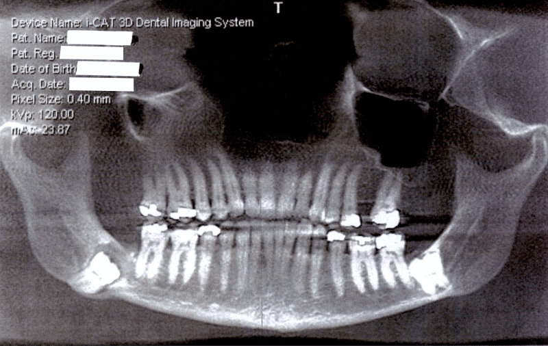 A Photo of Impacted Wisdom Teeth